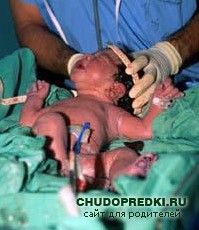 Роды после кесарева сечения