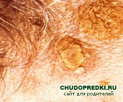 Себорея и методы лечения