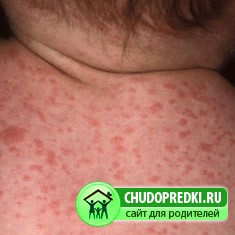 Потница у детей