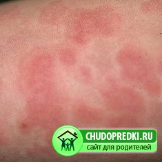 Крапивница у детей