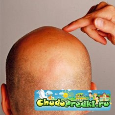 Лечение мужского облысения