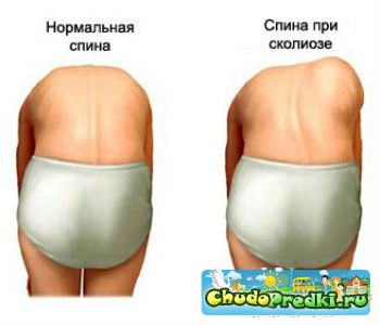сколиоз