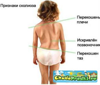 сколиоз лечение