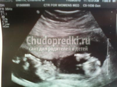 Признаки двойни на ранних сроках
