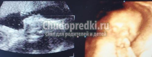 Узи 22 недели