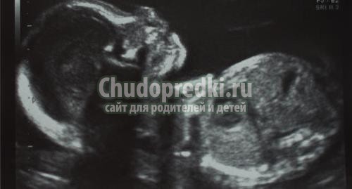 Узи 22 недели