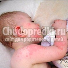 Аллергическая сыпь у ребенка