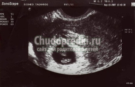 УЗИ 5 недель
