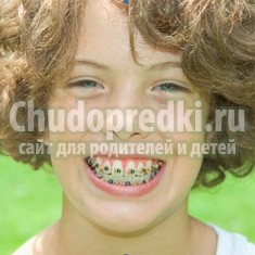 Особенности исправления прикуса у детей