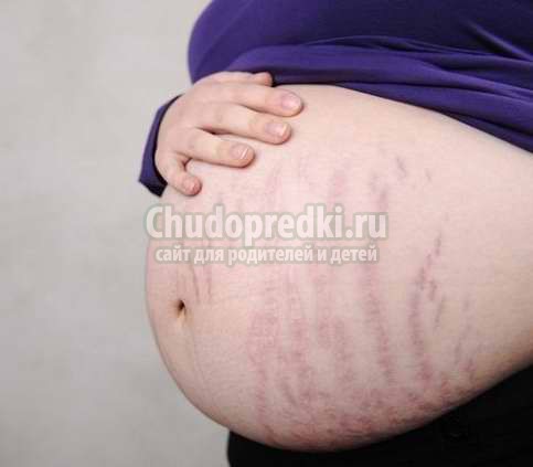 Уход за кожей во время беременности или как бороться с растяжками