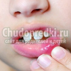 Разновидности детского стоматита