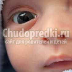 У ребенка слезится один глаз: причины и методы лечения