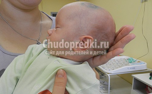Клиники Израиля предлагают современное лечение гидроцефалии
