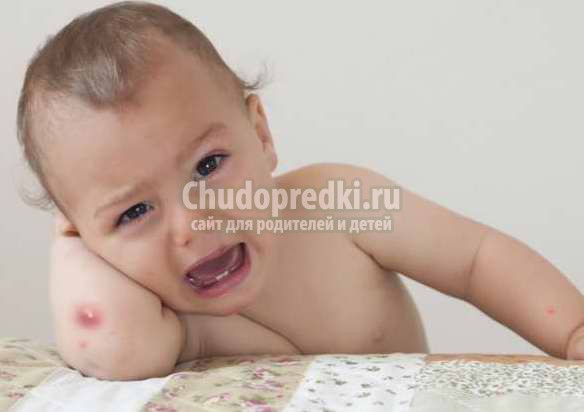 Фурункул у ребенка: как лечить?