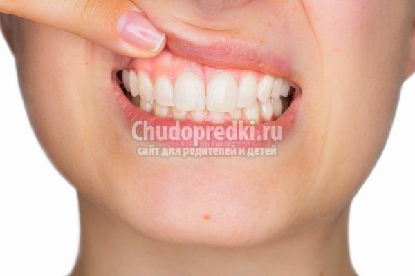 Гингивит у взрослых. Как лечить?