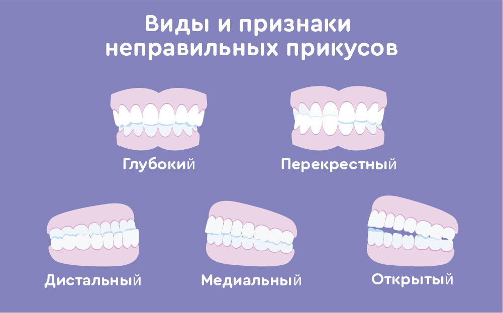 Что представляет собой прикус и почему его корректировка необходима?